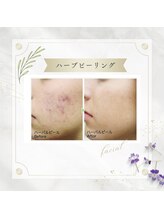 アディッシモ(addissimo)/気になる跡や赤みにも☆