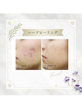 アディッシモ(addissimo)/気になる跡や赤みにも☆