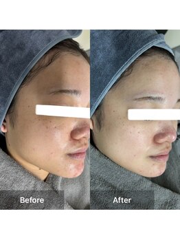 モカ 天王寺店(MOKA)/剥離ハーブピーリングニキビケア