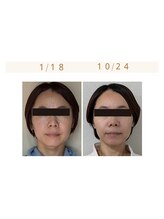 ミヤビ(miyabi)/小顔矯正