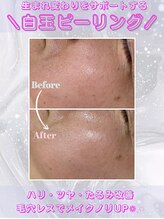 レイビス 盛岡店(RAYVIS)/【白玉肌】白玉ピーリング