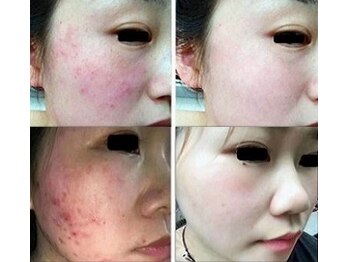 ナチュレアンドメディカ(Nature&Medica)/ニキビ専門ケア(プラズマ)