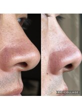 ホワイトアクア 浜松店(WHITE AQUA)/ハイドラワン/毛穴洗浄