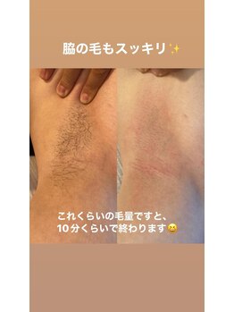 ララルアナ(Lara luana)/黒ずみ&ザラつきOFF!脇ケア◎