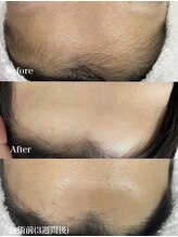 ナナイロサロン ニコリー(NaNairo nicolly)/【おでこワックス+光脱毛】2回目