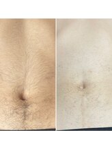 クリスエデン(Clyseden)/メンズ脱毛　お腹＆胸