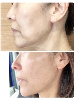 ファソ ブロウアンドアイズ(fasol)/小顔コース6回+エクソソーム1回