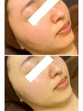 チュチュ(TUTU)/鎮静・水分補給で赤み一掃