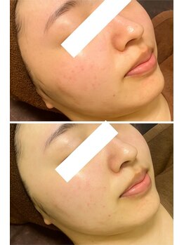 チュチュ(TUTU)/鎮静・水分補給で赤み一掃