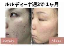 ヨサパーク ポノン(YOSA PARK ponon)/【Before→After】