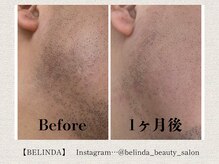 ベリンダ(BELINDA)/脱毛 (認定脱毛講師 在籍サロン)