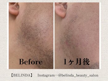 ベリンダ(BELINDA)/脱毛 (認定脱毛講師 在籍サロン)