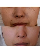 エトル(etole)/30代お客様症例写真