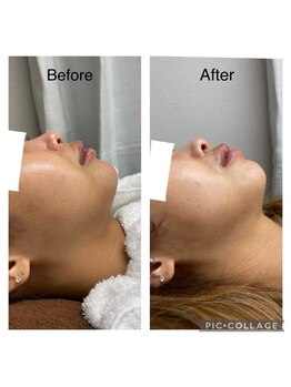 エンチャント(ENCHANT)/ウルトラお顔超音波リフト