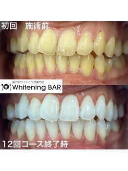 ホワイトニングバー 福島店/12回コース終了ビフォーアフター