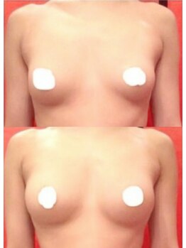 エンネソルミオ(Enne Solmio)/光バスト!