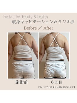 ルシアル(Rucial)/痩身◇ビフォー／アフター