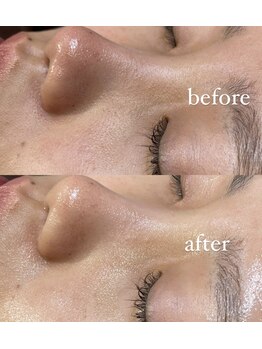 レシェルサロン(Lechelle Salon)/ハーブピーリング