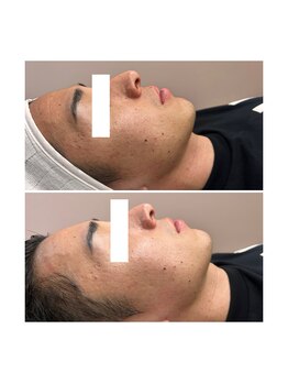 ホワイトワックス 京都四条烏丸(WHITE WAX)/《全顔》フェイシャルワックス