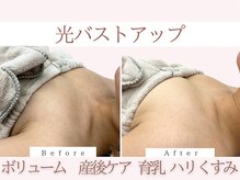 Cスキンケアクリニック 麻布店/光バストアップBeforeAfter#麻布