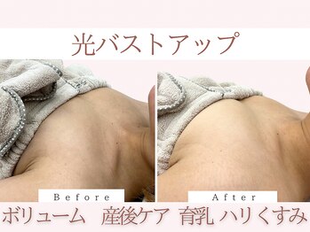 Cスキンケアクリニック 麻布店/光バストアップBeforeAfter#麻布