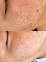 リノ沼津(Lino)/ニキビケアシミケア肌質改善