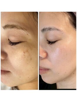 ファソ ブロウアンドアイズ(fasol)/テラボーラー6回エクソソーム3回