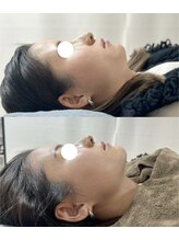 カノア(KANOA)/お顔のぽにょ取り