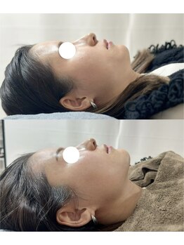 カノア(KANOA)/お顔のぽにょ取り