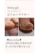 プリード 日進香久山店(PULIDO)/巻き爪フレックスプレート