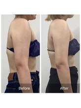 ダリア(Dahlia)/二の腕引き締め