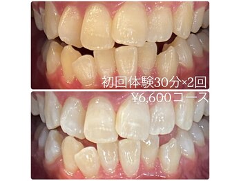 ホワイトニングルーム 横浜店(Whitening Room)/セルフホワイトニング/横浜