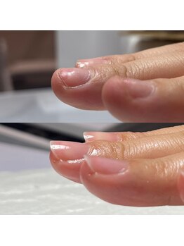 セラキュアネイル(Theracure nail)/爪が傷みペラペラボロボロ