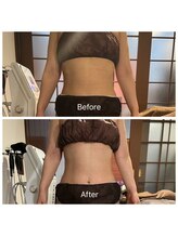 アムスパ(Aum Spa)/お腹周り脂肪分解液導入