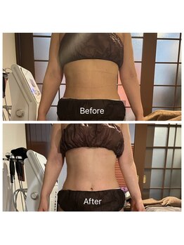 アムスパ(Aum Spa)/お腹周り脂肪分解液導入