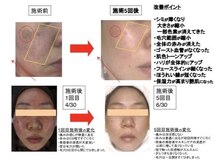 ビューティーサロン リリー(Lily)/シリカピーリング