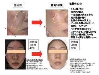 ビューティーサロン リリー(Lily)/シリカピーリング