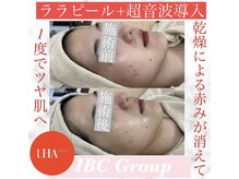 IBC 上大岡店/ララピール＋超音波導入