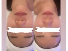 メゾン アンジュ(Maison Ange)/【小顔フェイシャルコース】