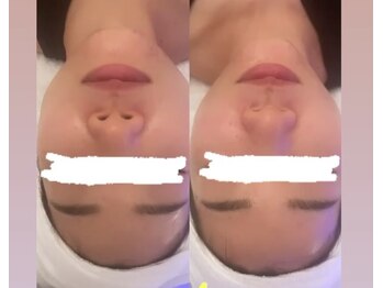 メゾン アンジュ(Maison Ange)/【小顔フェイシャルコース】