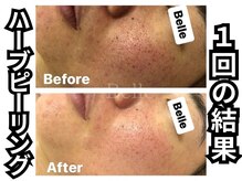 ベル 心斎橋店(Belle)/ハーブピーリング