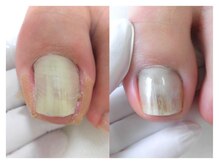 巻き爪ケアサポート ルアナ(LUANA)/Before→After