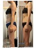 人気No 1!セル脂肪燃焼&分解深部ラジオ波＋排出リンパマッサージ(全身) 120分