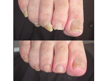 フットケア クラッシー(footcare classy)の雰囲気（分厚い爪の爪切りもお任せください♪）