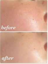 イーストモア(EAST MOIS)/W光フェイシャルで毛穴改善