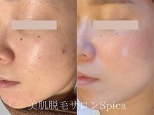 スピカ(SPICA)/美肌を目指しませんか？