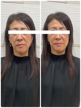 長寿鍼灸院 長寿整骨院/美容鍼50本の効果★ハリ・ツヤ