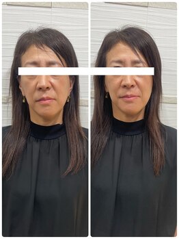 長寿鍼灸院 長寿整骨院/美容鍼50本の効果★ハリ・ツヤ