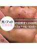 【毛穴もニキビケアも】フォト美顔×部分ピーリング×VC導入￥16500→￥11000