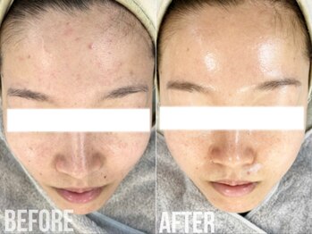 煌(kirameki)/【ニキビ】毛穴洗浄+micostella